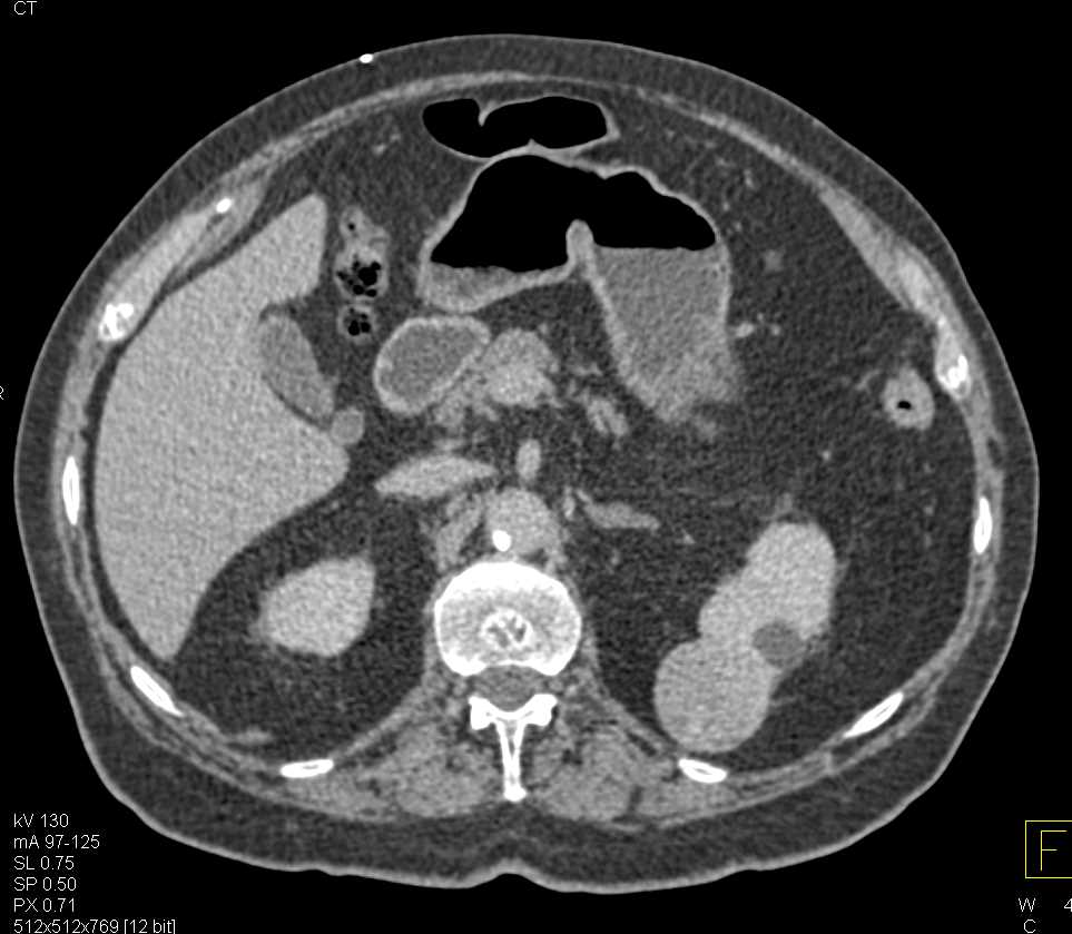 High Density Left Renal Cyst - CTisus CT Scan