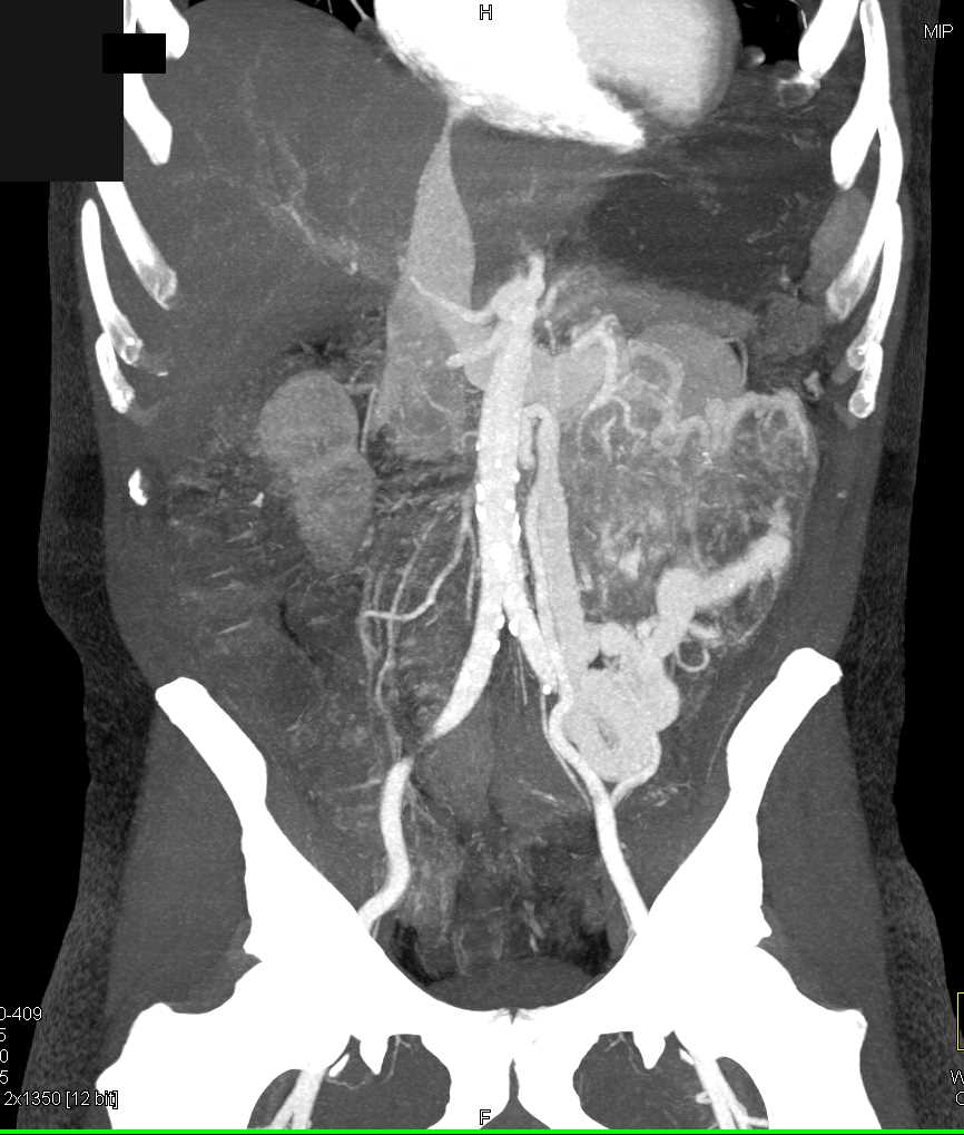 Clear Cell Renal Cell Carcinoma with AV Shunting - CTisus CT Scan