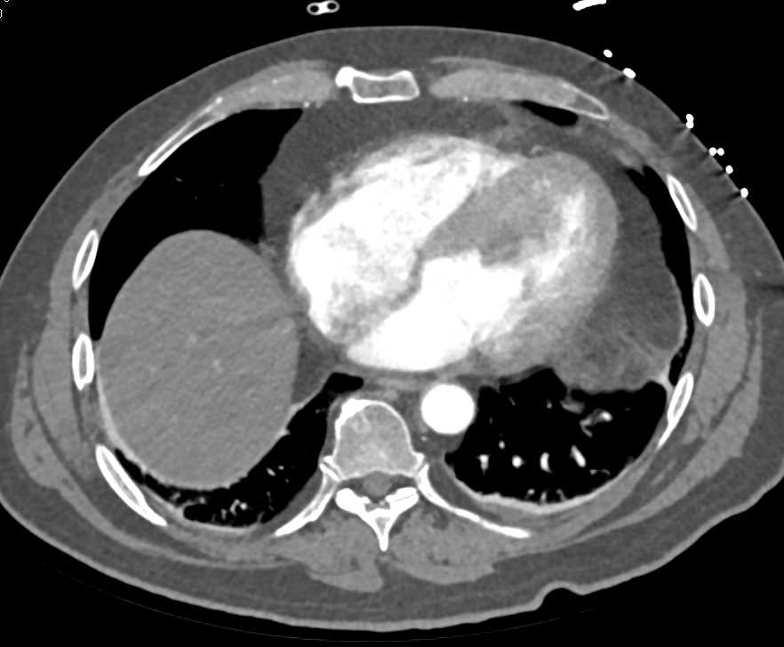 Multiple Renal Infarcts - CTisus CT Scan