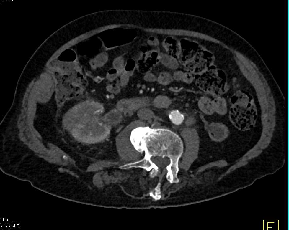 TCC Right Kidney - CTisus CT Scan