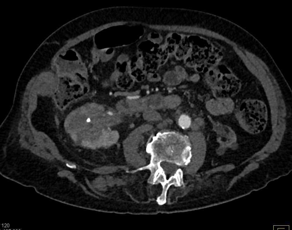 TCC Right Kidney - CTisus CT Scan