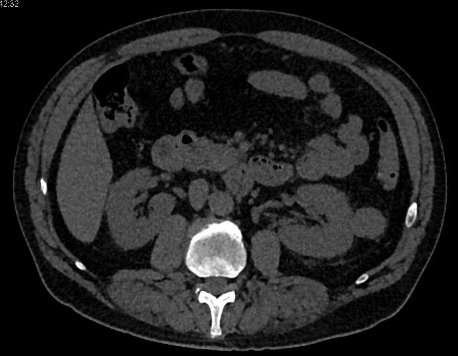 Implant in Left Pararenal Space - CTisus CT Scan