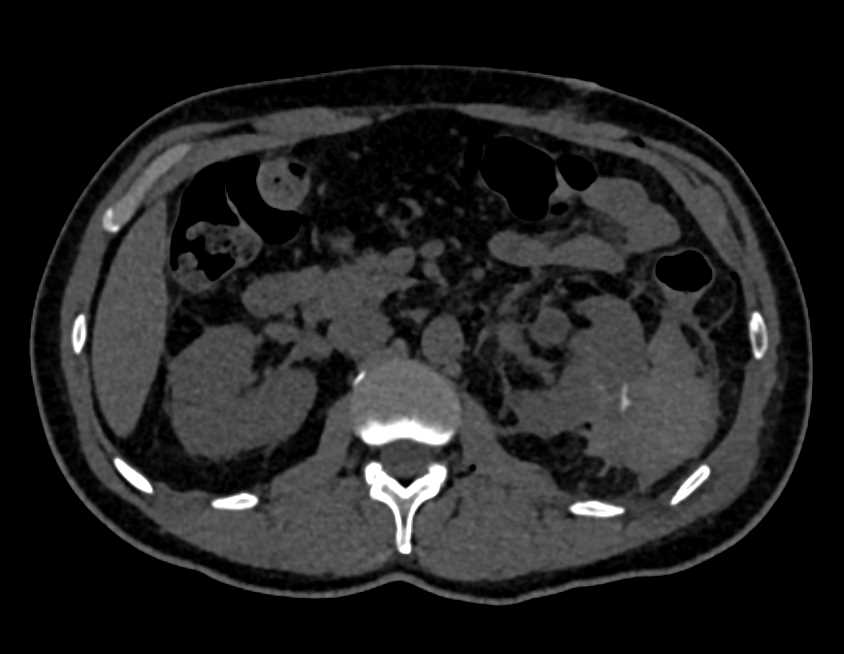Renal Artery Pseudoaneurysm and Bleed - CTisus CT Scan