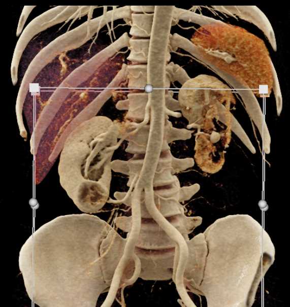Renal Artery Pseudoaneurysm and Bleed - CTisus CT Scan