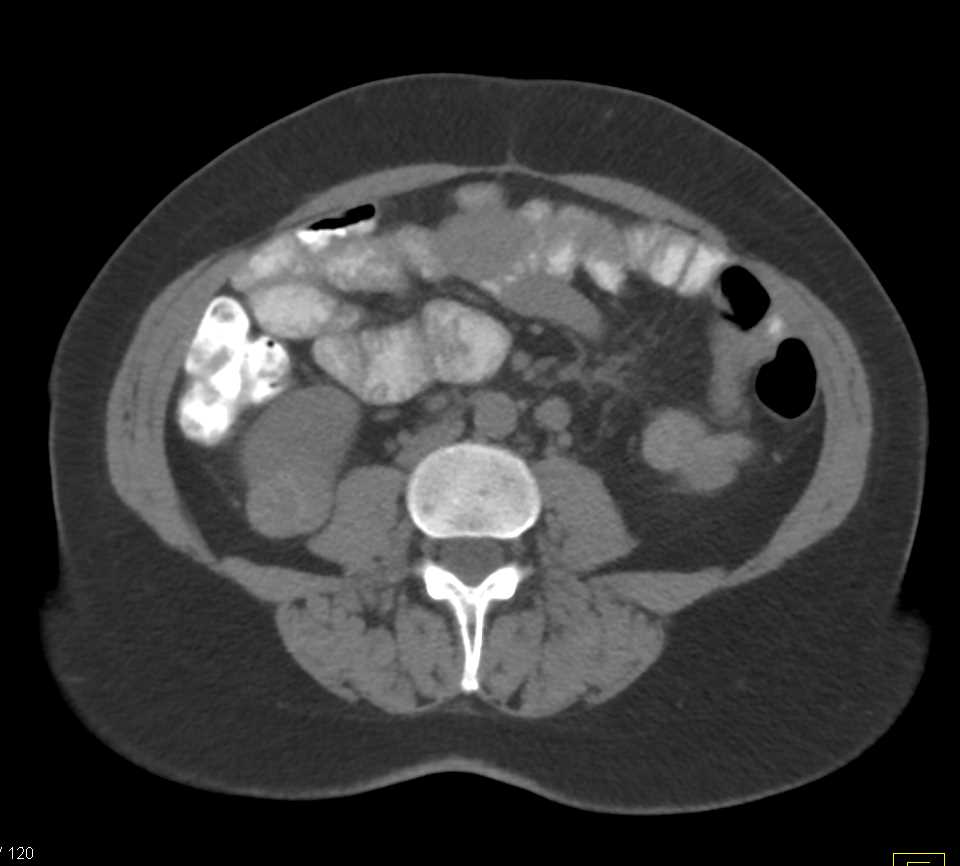 Papillary Renal Cell Carcinoma - CTisus CT Scan