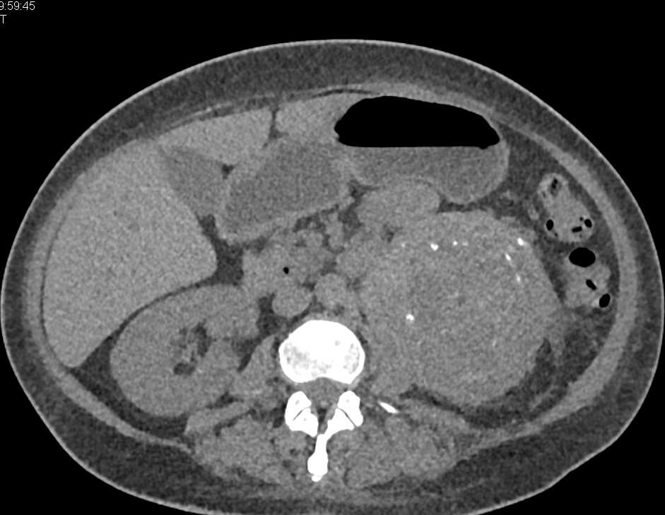 Retroperitoneal Fibrosis - CTisus CT Scan