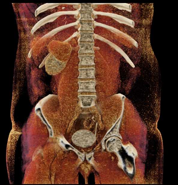 Papillary Renal Cell Carcinoma - CTisus CT Scan