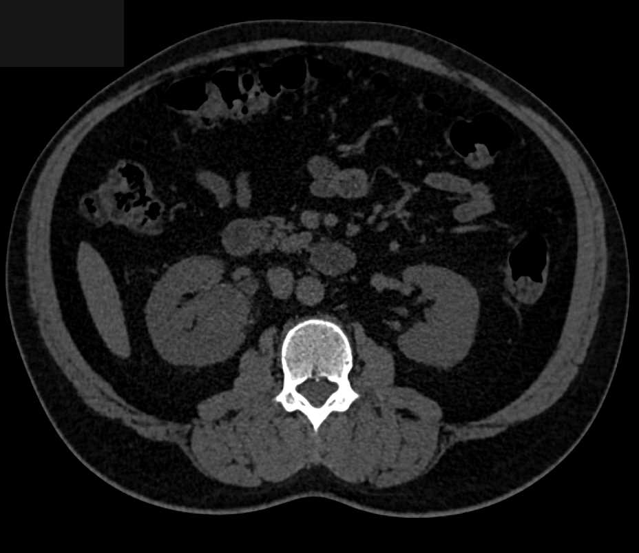 Transitional Cell Carcinoma Right Kidney - CTisus CT Scan