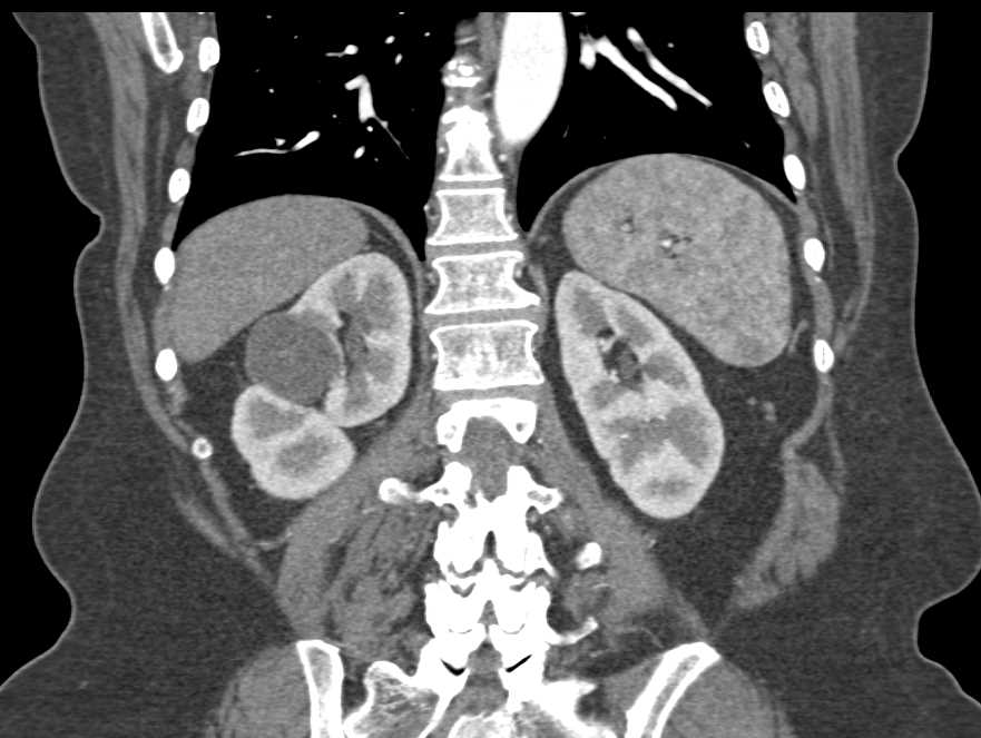 Bosniak 2F Cyst - CTisus CT Scan