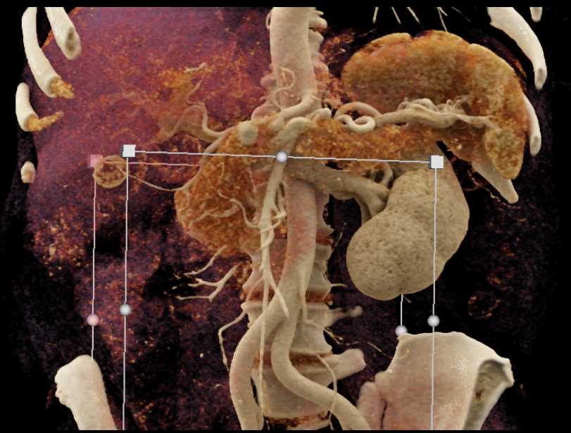 Renal Cell Carcinoma with Pancreas Metastases and Metastases to Contralateral Kidney and Liver - CTisus CT Scan