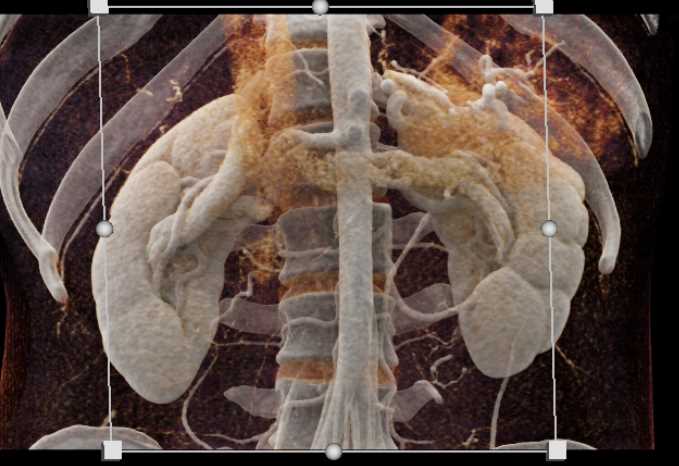 Left Renal Ureteropelvic Junction (UPJ) - CTisus CT Scan