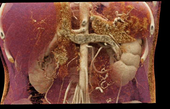 Left Extrarenal Pelvis with CR - CTisus CT Scan