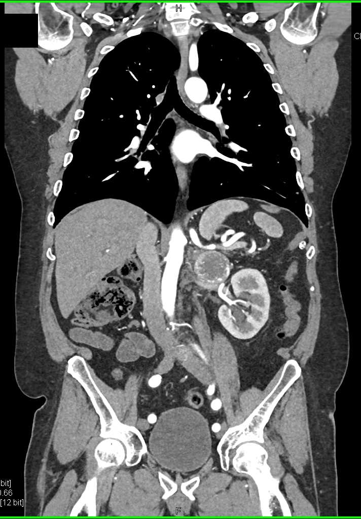 Renal Cell Carcinoma with Metastases to Pancreas and Adrenal - CTisus CT Scan