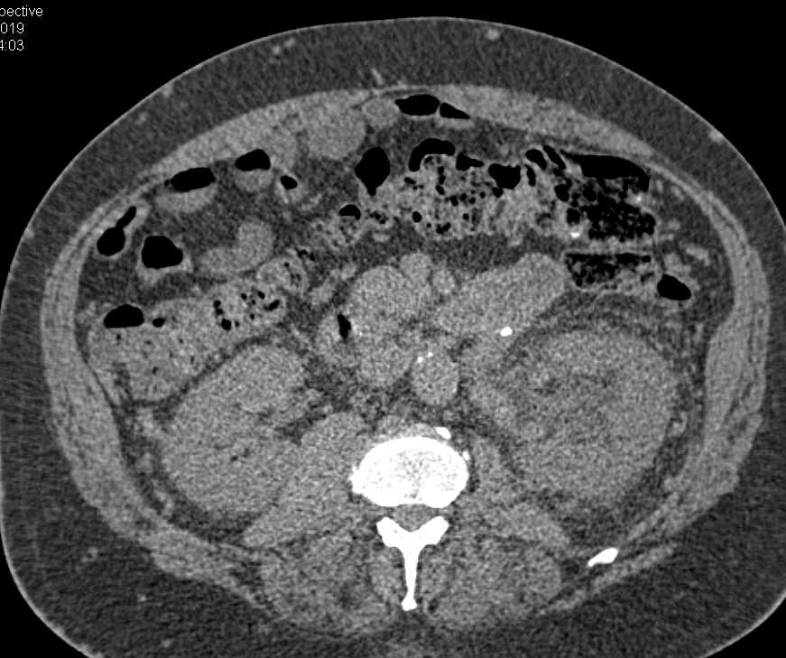 Perirenal Infiltration Left Kidney with Renal Vein Thrombosis - CTisus CT Scan