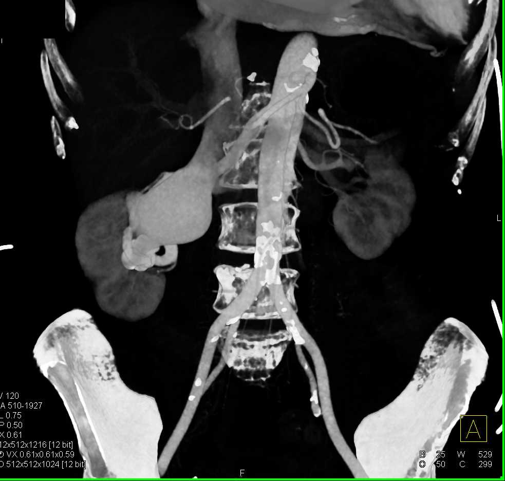 Arteriovenous (AV) Fistulae Right Kidney - CTisus CT Scan