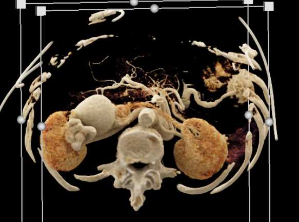 Arteriovenous (AV) Fistulae Right Kidney - CTisus CT Scan