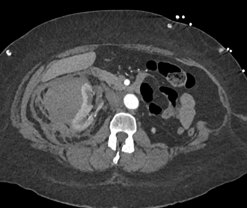 Page Kidney - CTisus CT Scan