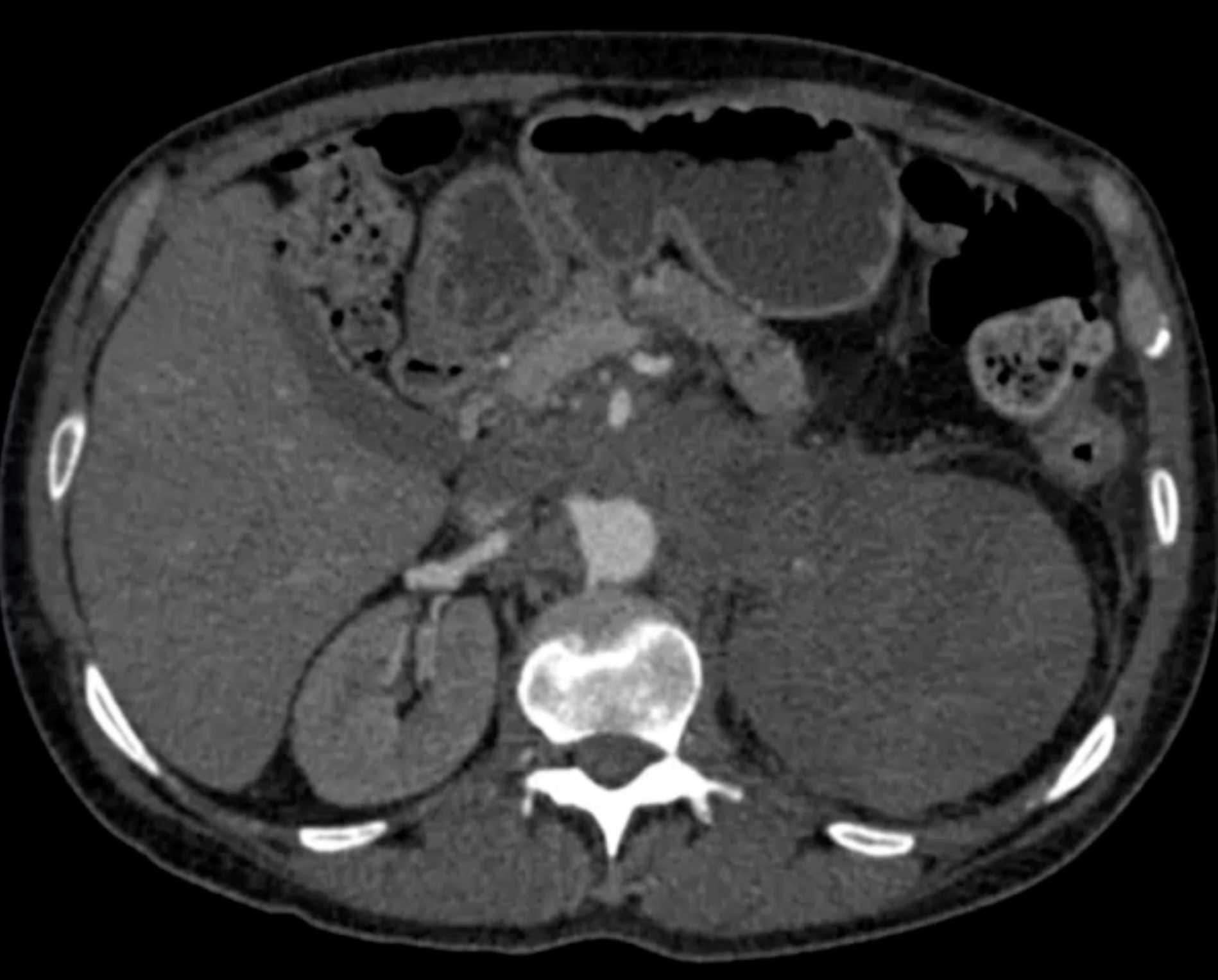 Epithelioid Angiosarcoma of the Left Kidney - CTisus CT Scan