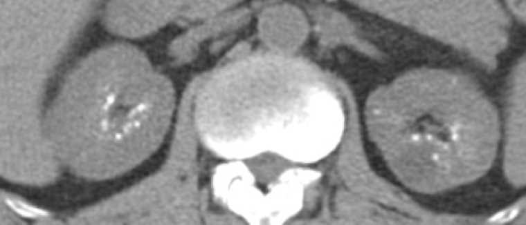 Medullary Calcinosis with Lung Metastases - CTisus CT Scan