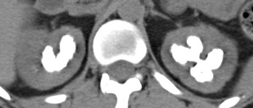 Medullary Nephrocalcinosis - CTisus CT Scan