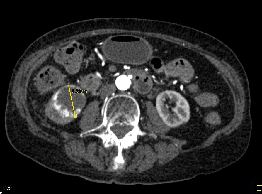 Clear Cell RCC with Neovascularity in Tumor - CTisus CT Scan