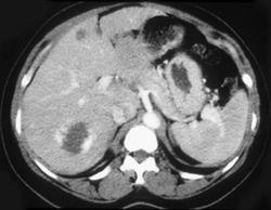 Hemangioma - CTisus CT Scan