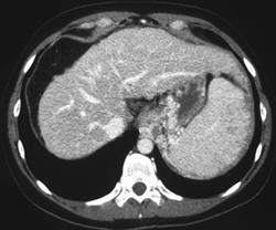 Gastric Varices - CTisus CT Scan