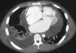 Cardiac Cirrhosis Due to Poor Cardiac Function (pericardial Effusion) - CTisus CT Scan