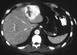Hemangioma - CTisus CT Scan