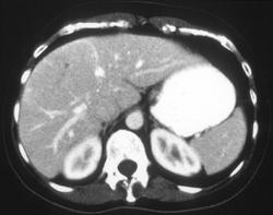 False Negative Ct: Focal Nodular Hyperplasia - CTisus CT Scan