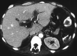 Portal Vein Thrombosis - CTisus CT Scan