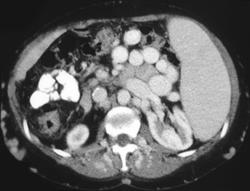 Cirrhosis With Large Varices and Splenomegaly - CTisus CT Scan