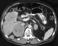 Hepatoma With Adrenal Metastases - CTisus CT Scan