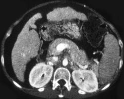 Pseudothrombosis of the Portal Vein on Arterial Phase Images - CTisus CT Scan