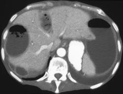 Multiple Hepatic Infarcts With Abscess Formation - CTisus CT Scan