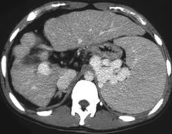 Dual Phase Cirrhosis With Varices - CTisus CT Scan