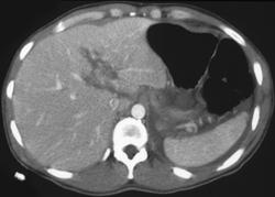 Liver Laceration - CTisus CT Scan