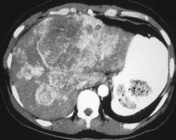Hypervascular Hepatoma - CTisus CT Scan