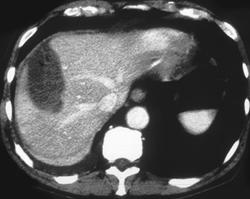 Hepatic Changes Following Cryosurgery - CTisus CT Scan