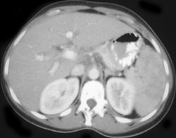 Chronic Active Hepatitis - CTisus CT Scan