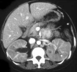 Bacillary Angiomatosis - CTisus CT Scan