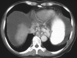Cirrhosis With Esophageal and Gastric Varices - CTisus CT Scan