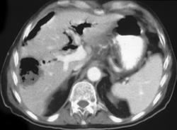 Liver Abscess and Pneumobilia - CTisus CT Scan