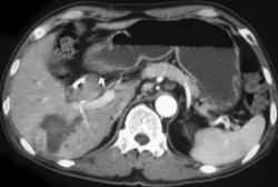 Hepatoma Seen Best on Portal Phase - CTisus CT Scan