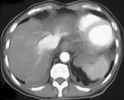 Torsion of the Gallbladder - CTisus CT Scan