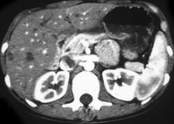 Caroli's Disease - CTisus CT Scan
