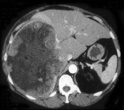 Hepatoma - CTisus CT Scan