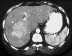 Hepatic Adenoma - CTisus CT Scan