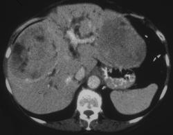 Multifocal Hepatoma - CTisus CT Scan