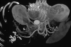 Nice Hepatic Artery - CTisus CT Scan